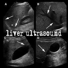 liver ultrasound