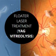 Best Eye Floaters Laser Treatment Cost Reviews