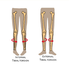 TORSION