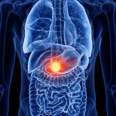 Immunotherapy Response in Pancreatic Cancer: What a New Study Reveals