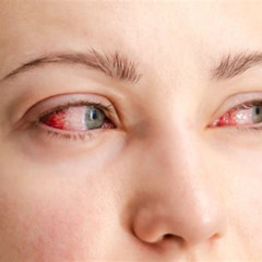 Best Bloodshot Eyes Causes And Treatments Reviews
