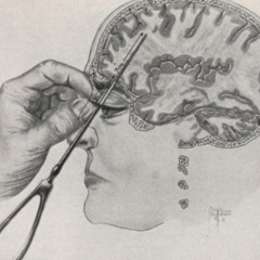 Lobotomy Scartissue (1)