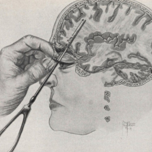 Lobotomy Scartissue (1)