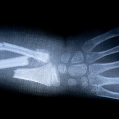 Broken Bones