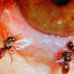 tendinite de l'oeil
