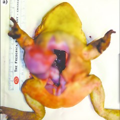 gangrene