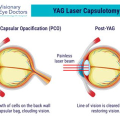 Best Laser Eye Treatment After Cataract Operation Reviews