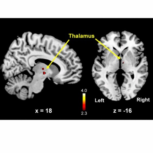Stream episode Altered Brain Morphology and Functional Connectivity in ...