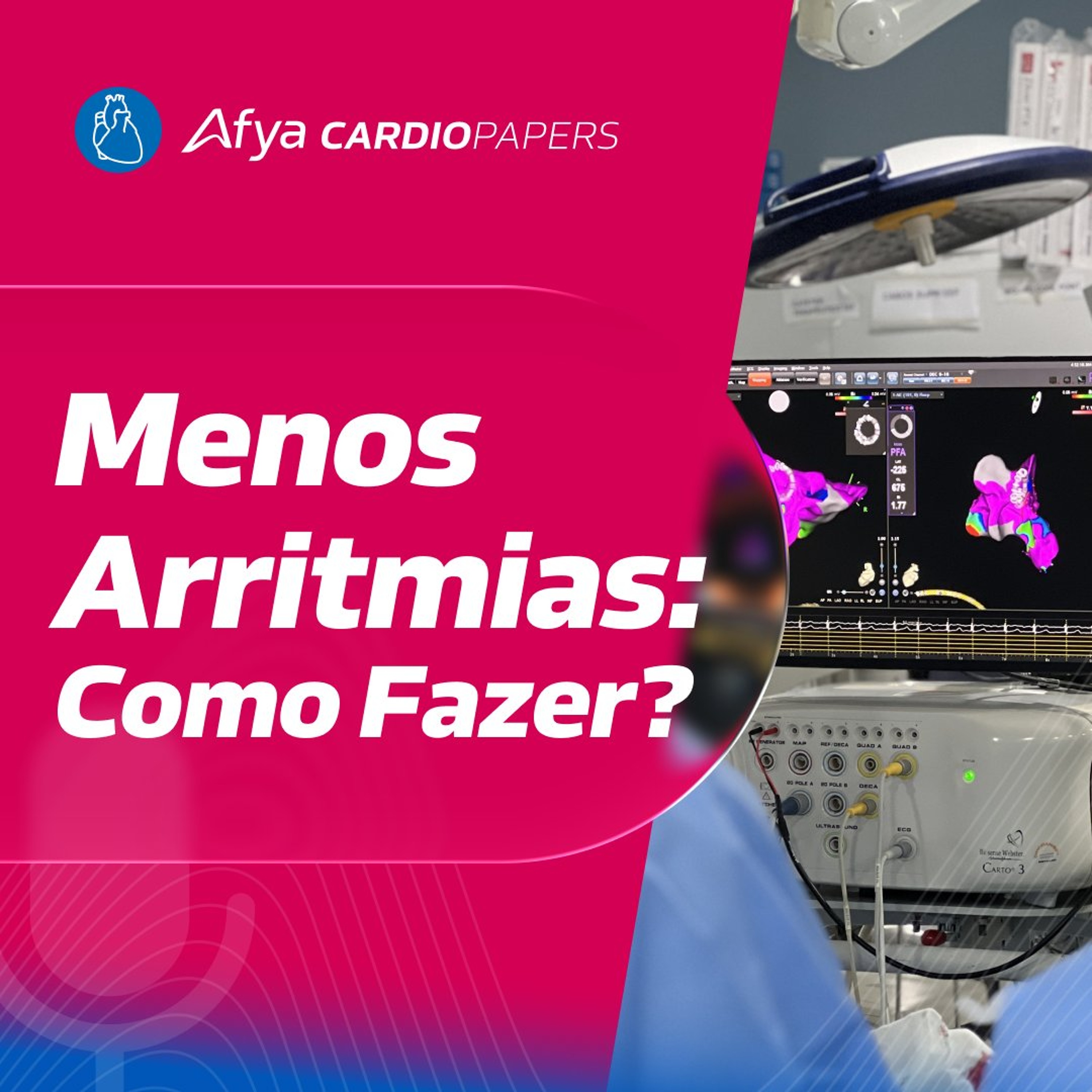 Como Reduzir a Carga Arrítmica na Cardiomiopatia Arritmogênica?