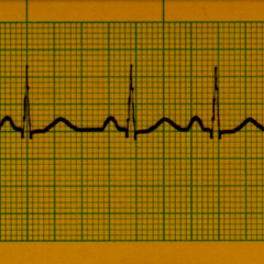 Arrhythmia
