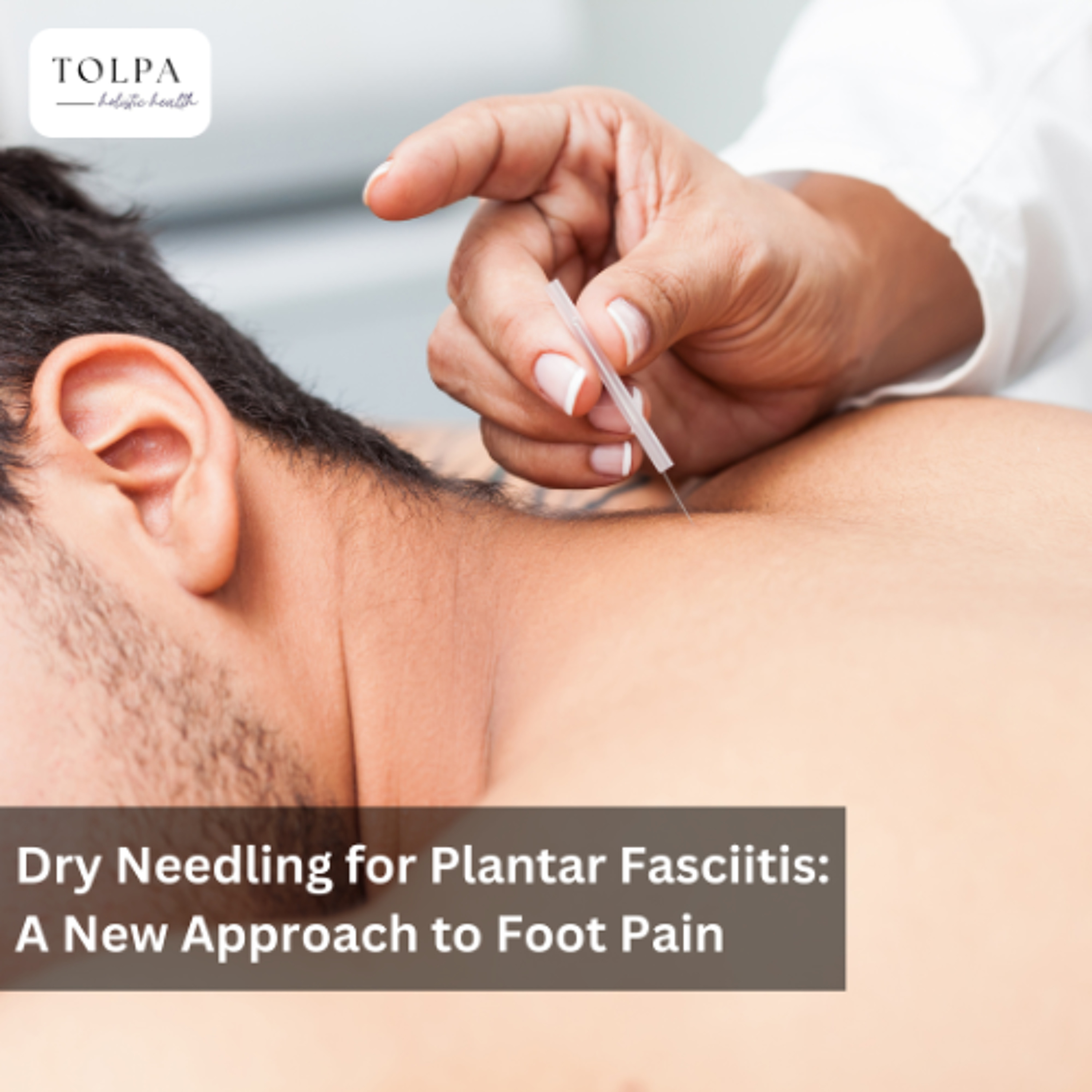 Dry Needling for Plantar Fasciitis: A New Approach to Foot Pain