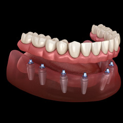 Dental Implants for Long-Term Oral Health