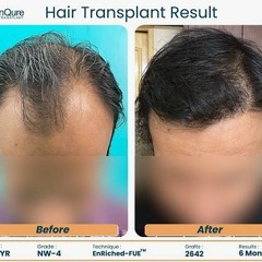 Which Technique Is Best FUT Vs FUE Technique Best Hair Transplant Surgeon- Dr. Jangid Delhi