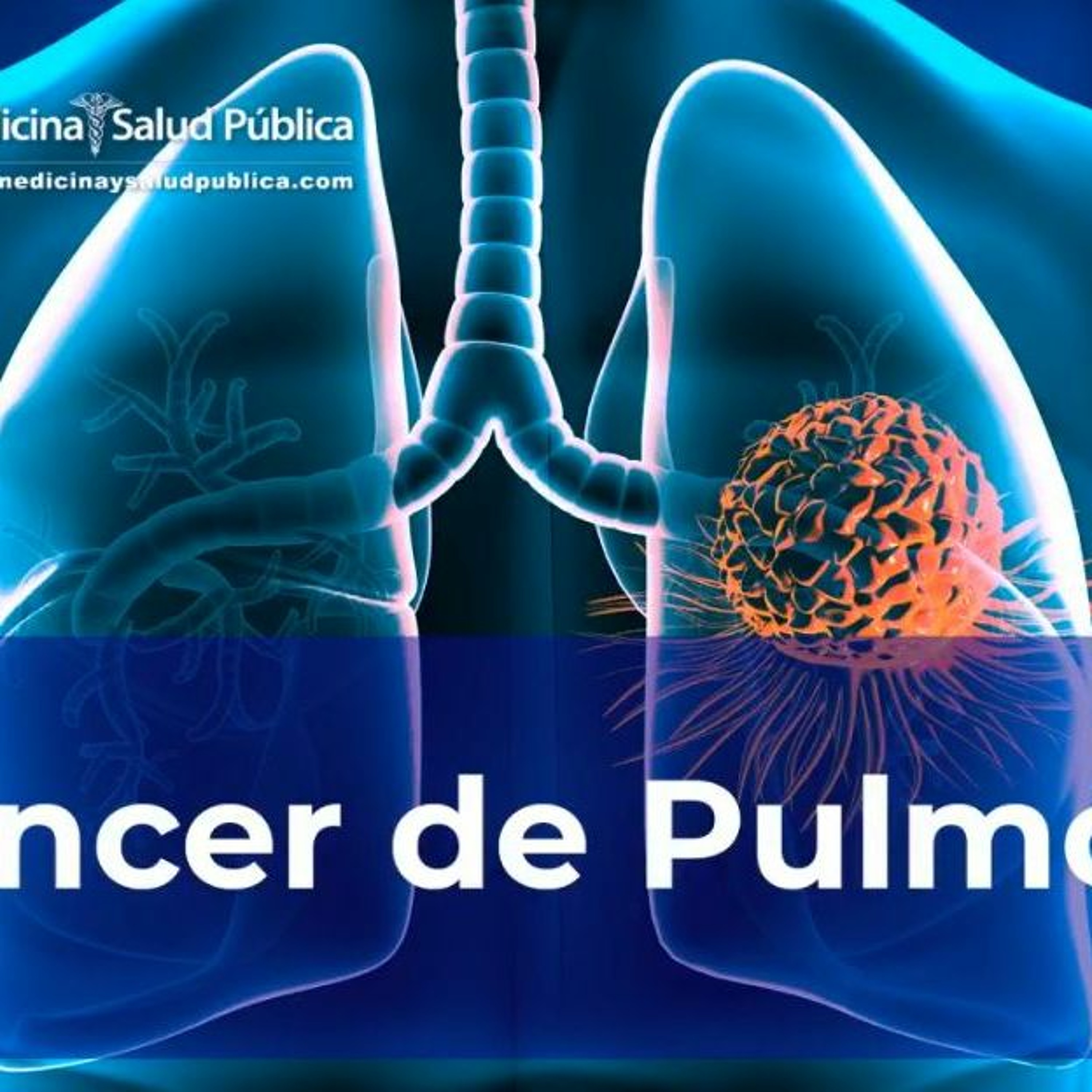 Cáncer De Pulmón