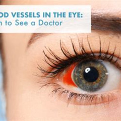 Best Blood Vessel Burst In Eye Treatment Reviews