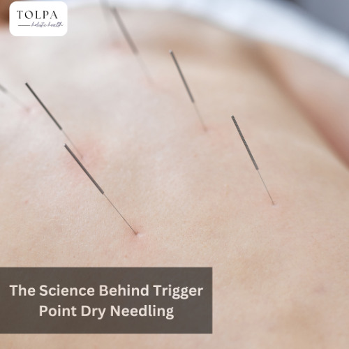 The Science Behind Trigger Point Dry Needling