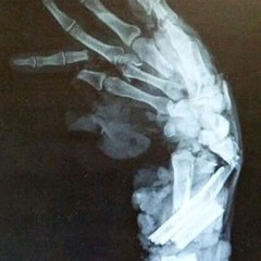 Protracción inexhaurible