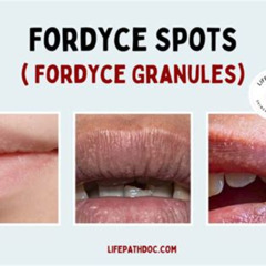 Best Fordyce Spots Under Eyes Treatment Reviews