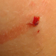skinnedknee