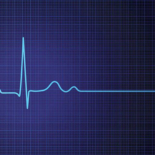 no_pulse_(S1)_154bpm_emin