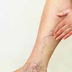 Venous Insufficiency Improvement | Increase Blood Flow & Reduce Pain and Swelling in Legs