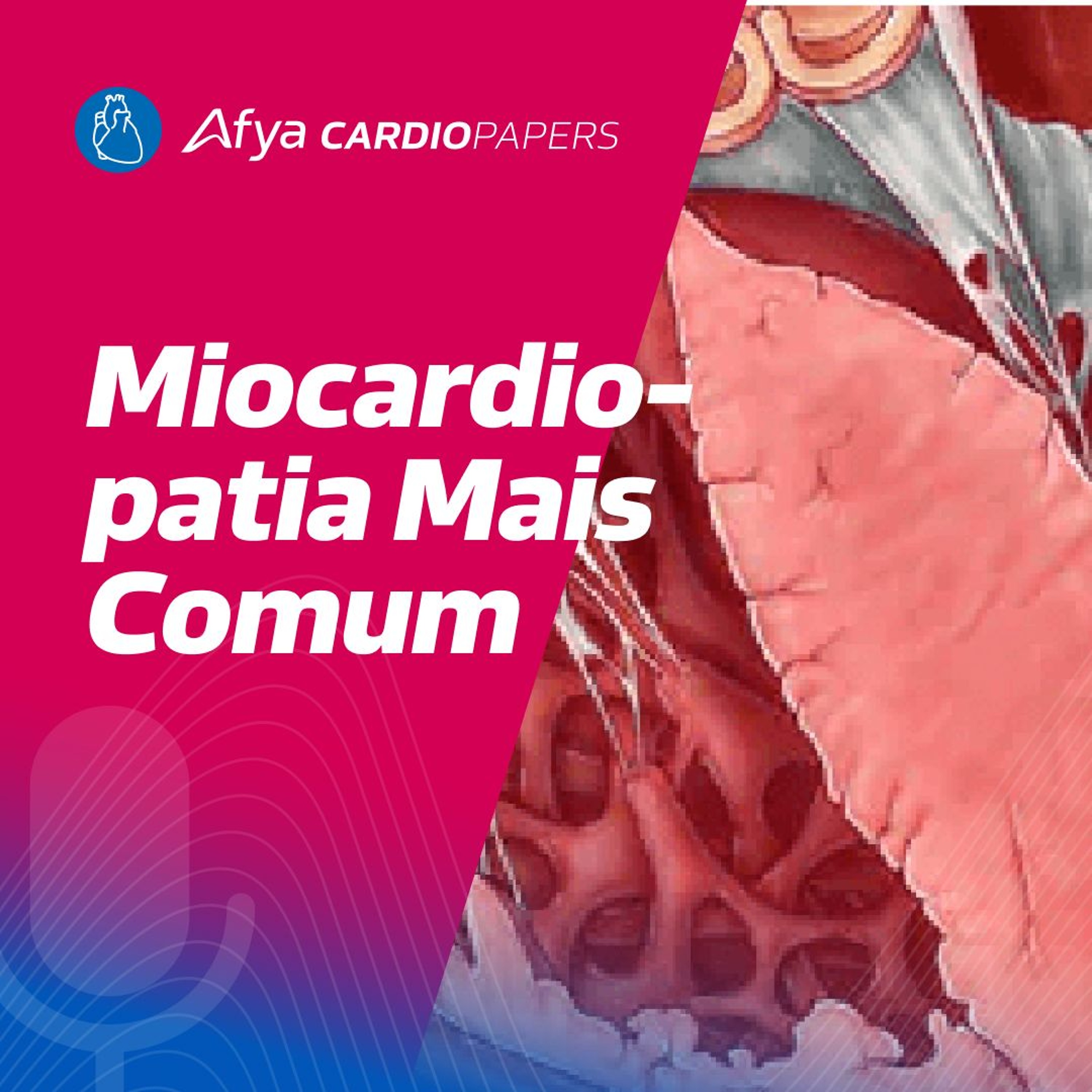 Qual o tipo mais comum de iocardiopatia? episode artwork