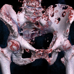 bone cancer