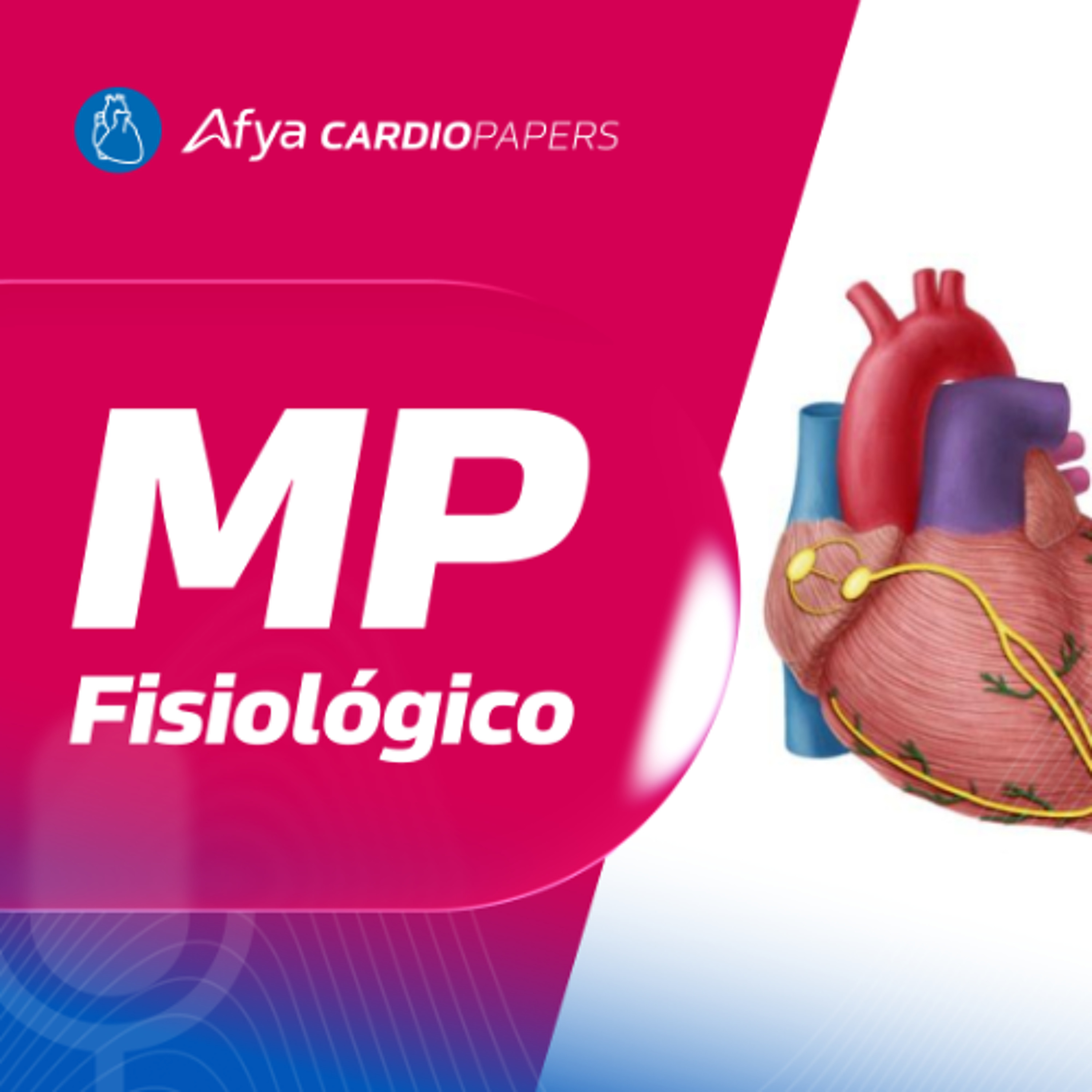 Marcapasso com estimulação fisiológica explicado