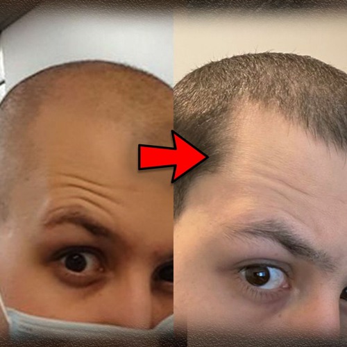 Stream Episode Severe Hair Loss Return From The Dead With The Big 3 By More Plates More Dates Podcast Listen Online For Free On Soundcloud