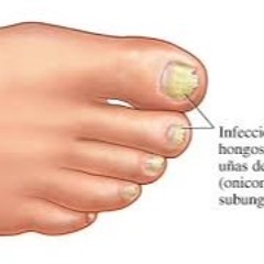 Enfermedades por hongos