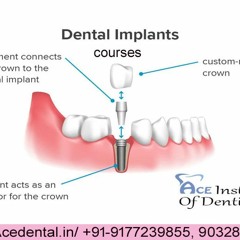Dental Implant Treatment and Courses in India