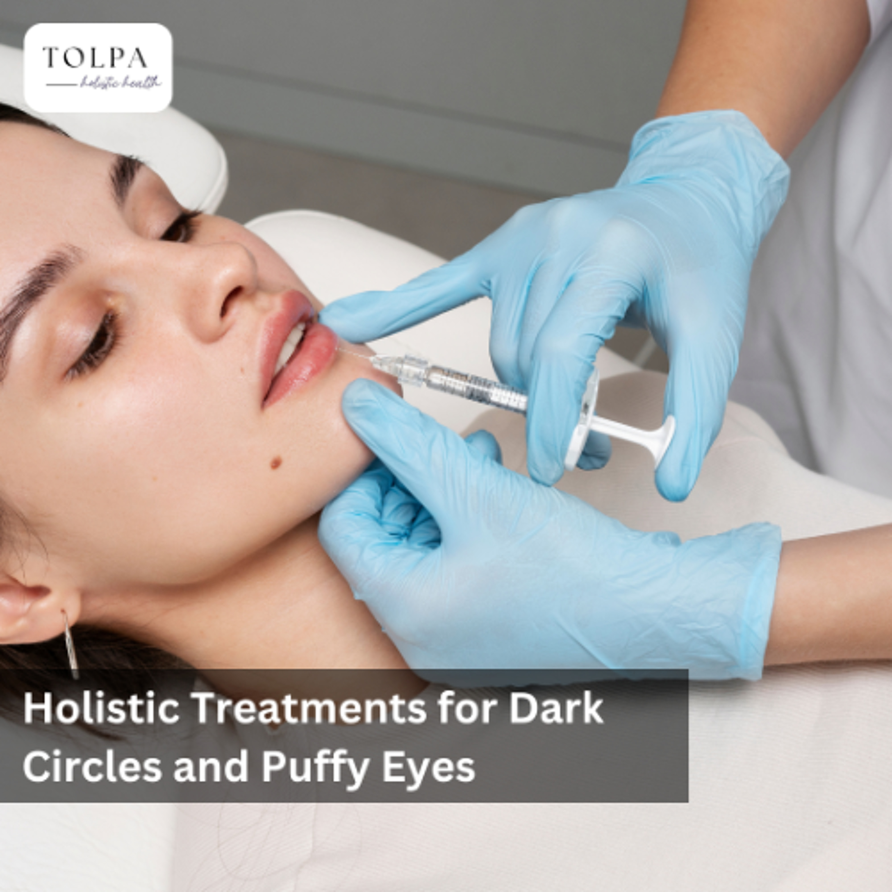 Holistic Treatments for Dark Circles and Puffy Eyes