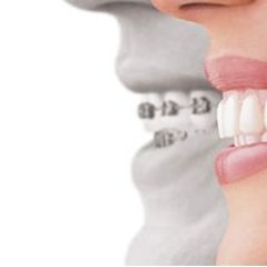 Transform Your Smile with Clear Self-Ligating Braces!