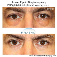 Best Prp Treatment Under Eyes Near Me Reviews