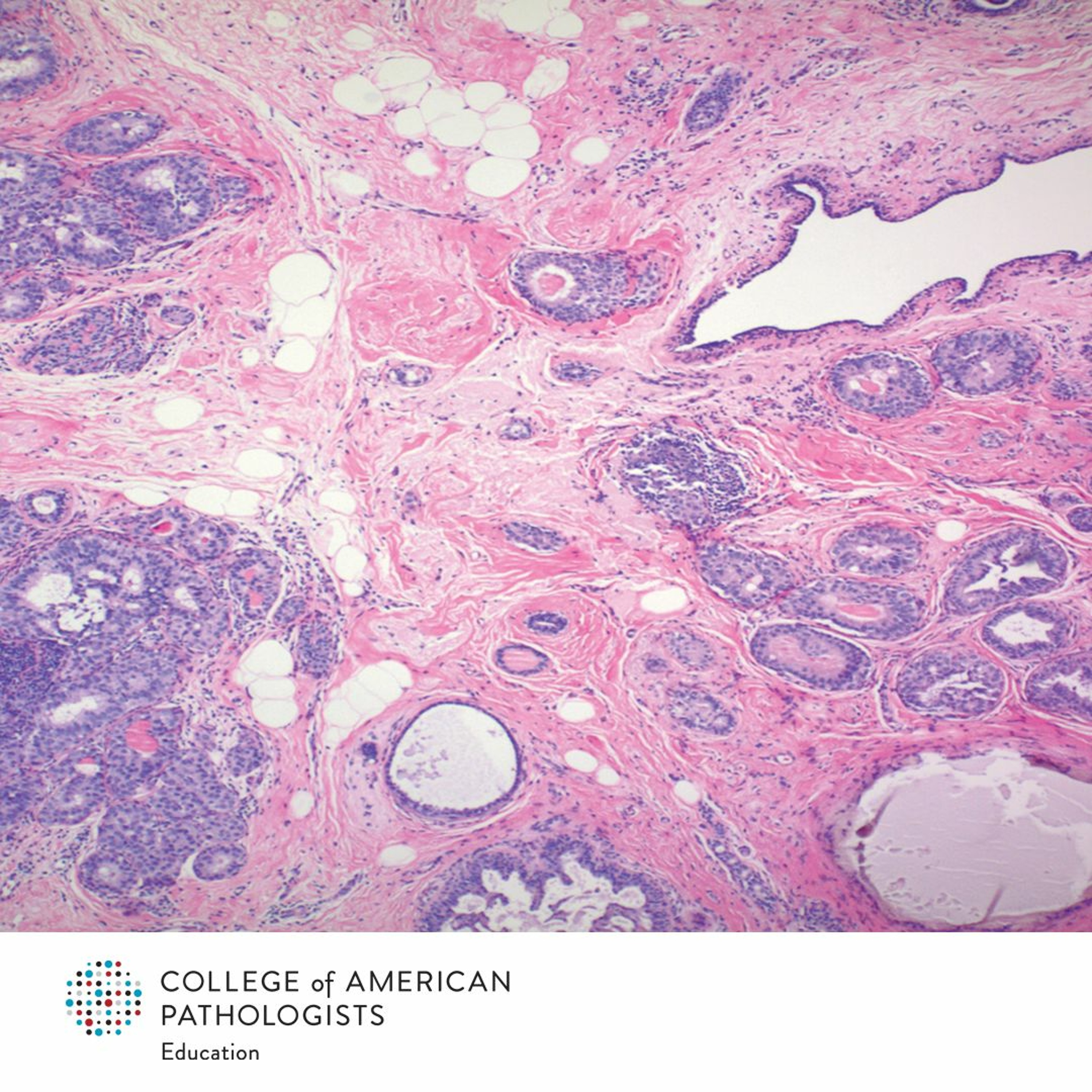 Leveling Up Your Breast Pathology Diagnostic Skills episode artwork