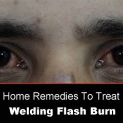 Best Welding Eye Burn Home Treatment Reviews