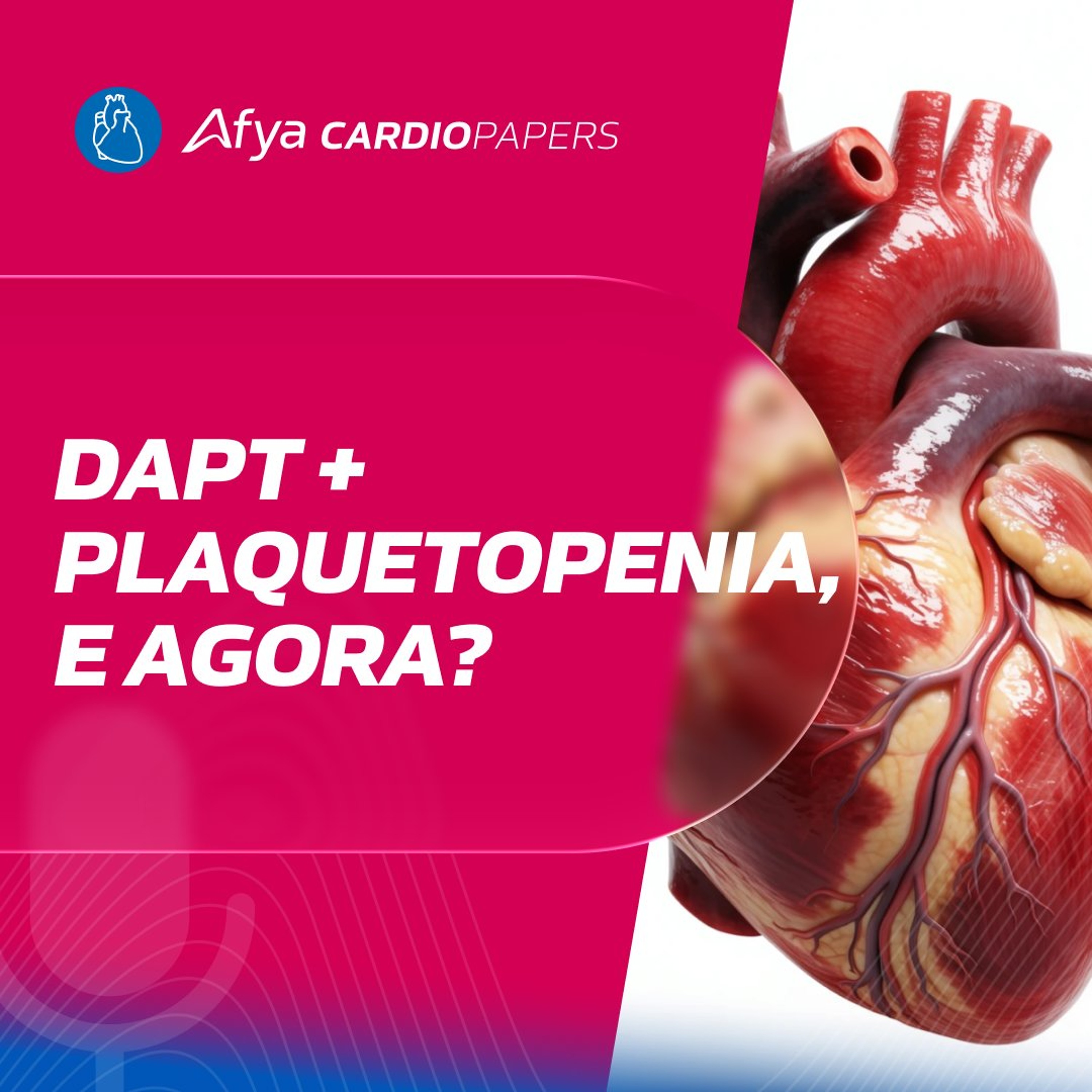 Plaquetopenia na SCA: quando suspender, manter ou ajustar a DAPT? episode artwork