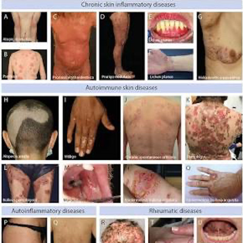 necrotizing fasciitis ((platonischer eimer))