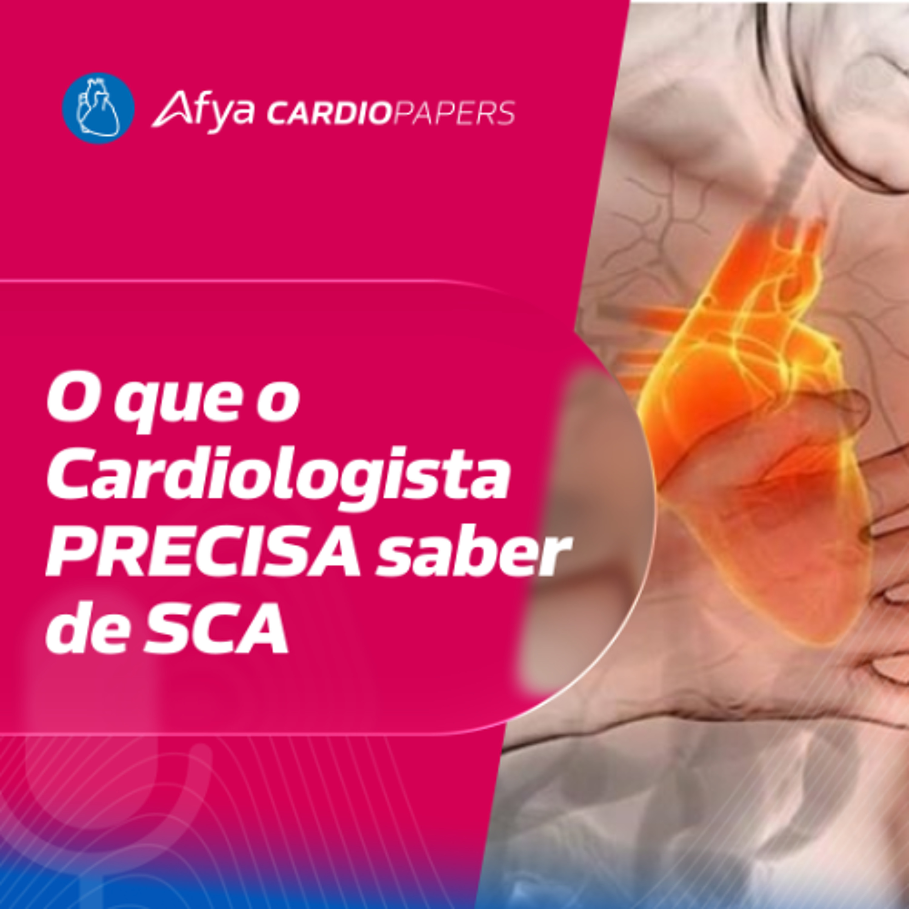 O que o Cardiologista PRECISA saber de SCA