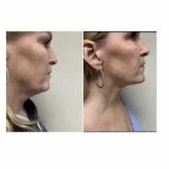 Coolsculpting Neck Cost Effective Alternatives and Comparable Treatments