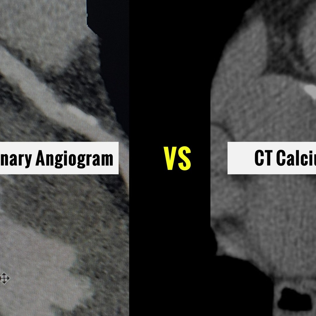 Stream episode CT Coronary Angiogram Vs CT Calcium Score by Heartcare ...
