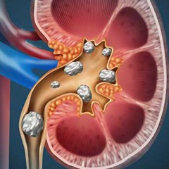 Kidney Stones Treatment | Expel Small Stones & Stop Crystals from Forming