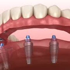 Are Implant-Supported Overdentures the Best Choice for Your Smile