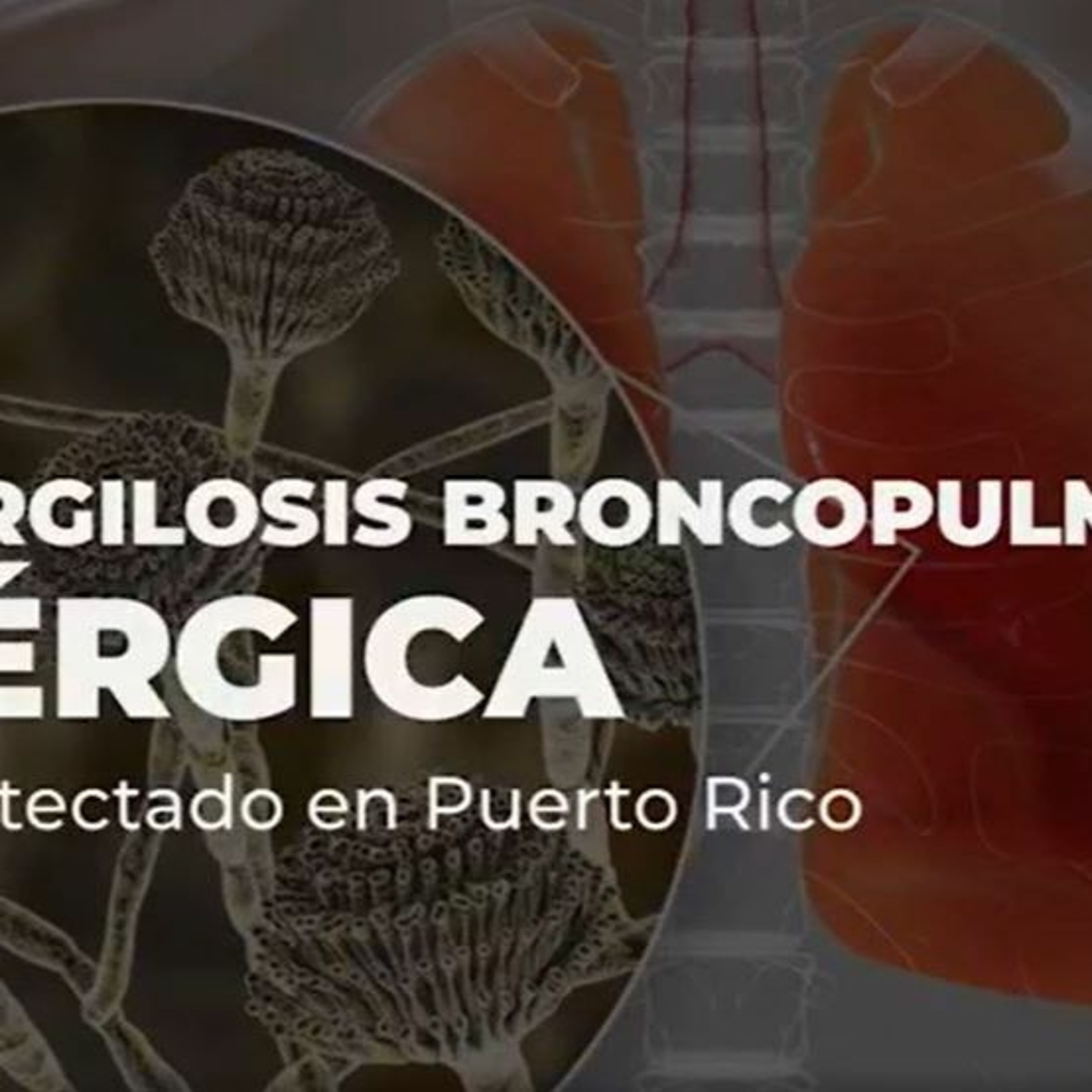 Aspergilosis Pulmonar