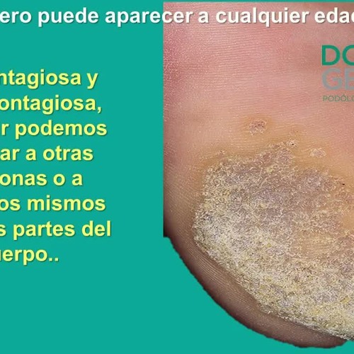 Delgado Corbata ecuador papiloma ojo de pescado biografía Conveniente