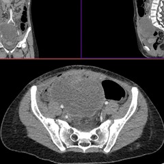 Response of BRAF-Mutated Spindle Cell Sarcoma to BRAF/MEK Inhibitors