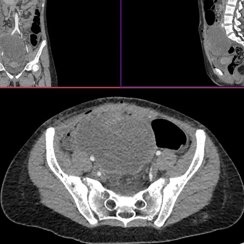 Response of BRAF-Mutated Spindle Cell Sarcoma to BRAF/MEK Inhibitors