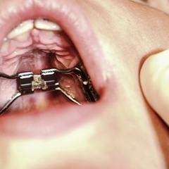 Who Should Opt For Maxillary Skeletal Expanders?