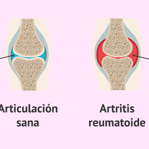 Stream RI Laynes Actividad 3 Alteraciones Inmunologicas By Rosa Laynes 