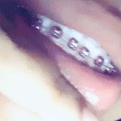 braces
